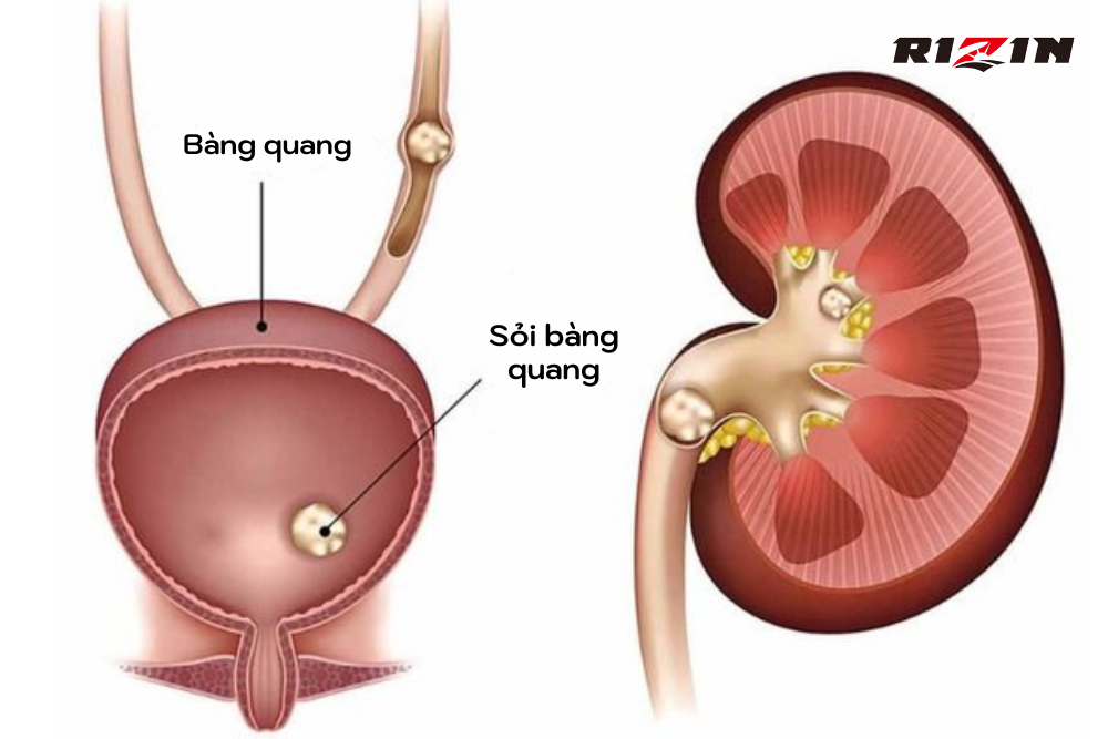 Sỏi bàng quang là bệnh gì?