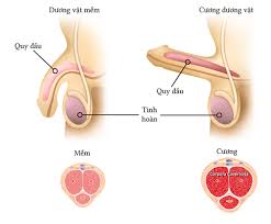 Dấu hiệu của chứng priapism nếu không xử lý sớm có thể dẫn tới hoại tử thể hang, rối loạn cương vĩnh viễn